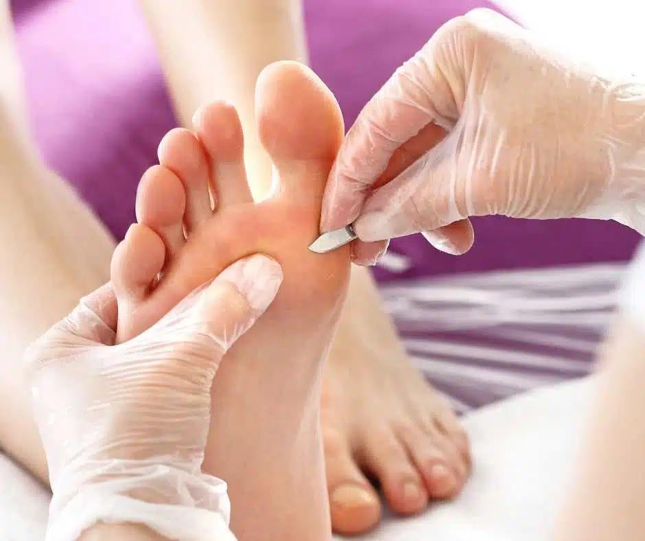 Foot healthcare professional treating a patient's callus