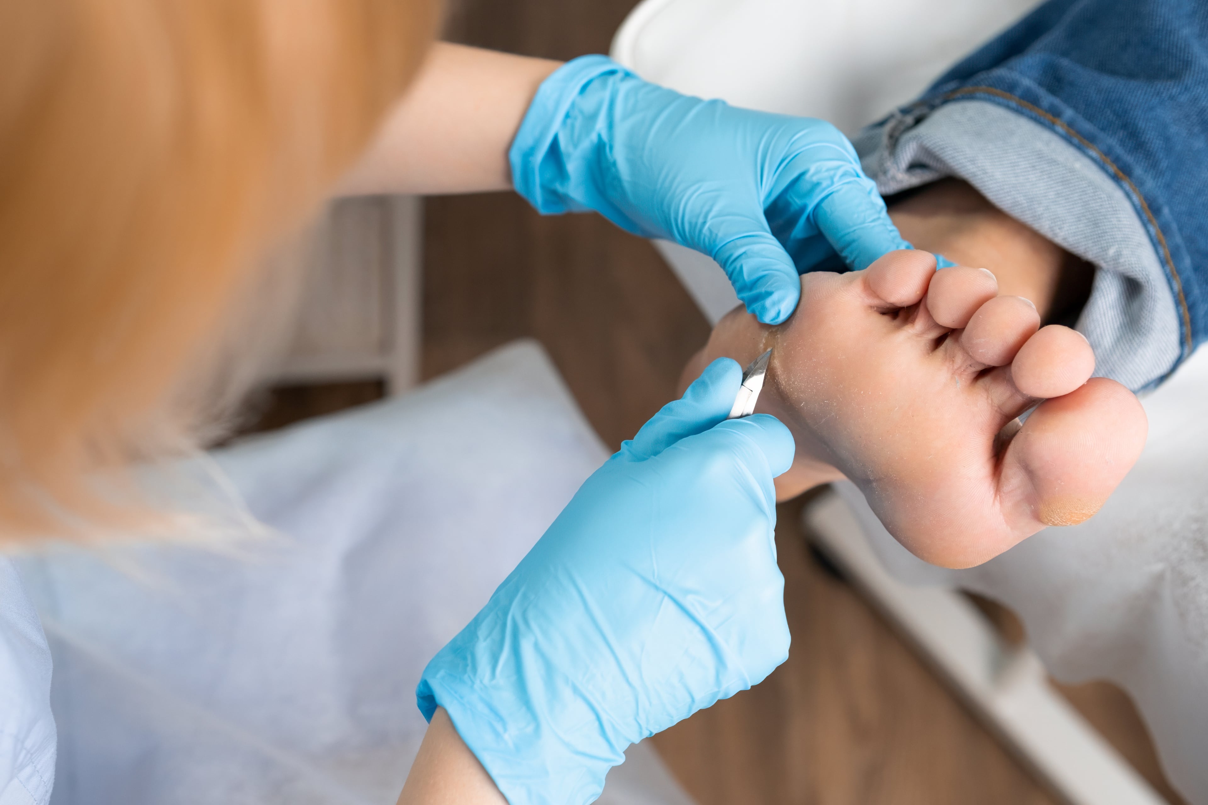 Foot healthcare professional treating a patient's corns