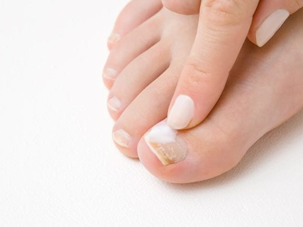 Foot heathcare professional pointing to a fungal nail