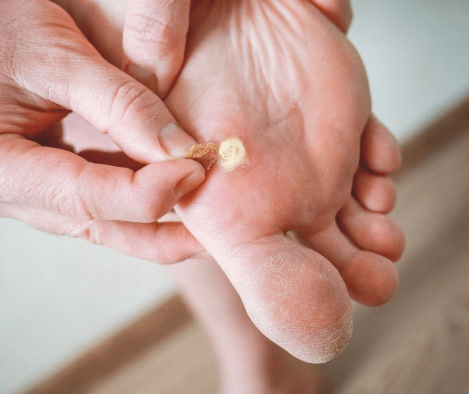 Foot healthcare professional treating a patient's verrucae